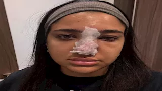 "مناخيري كانت هتروح".. كنزي مدبولي تكشف معاناتها مع حقنة الفيلر 