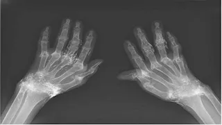 أطباء يكتشفون خيوط ذهب داخل ركبتي امرأة مسنة.. ما السبب؟