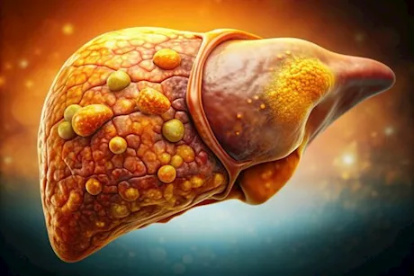 في أقل من شهر- طبيب يكشف طريقة لعلاج مرض الكبد الدهني