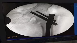 بتقنية متطورة.. نجاح جراحتين دقيقتين للعظام في مستشفى بالدقهلية (صور)