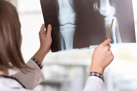 بعد سن الثلاثين.. أغذية ضرورية للحفاظ على العظام