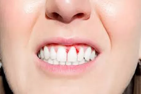 طرق طبيعية لإيقاف نزيف اللثة دون أدوية