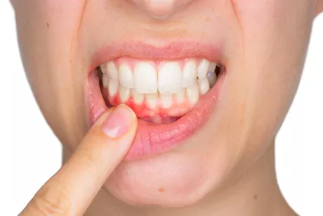 هل نزيف اللثة طبيعي أم يشير لمشكلة صحية؟