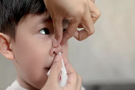 3 أسباب نادرة لنزيف الأنف عند الأطفال.. اعرفها
