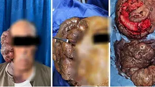 استئصال ورم ضخم يزن 2 كجم من وجه مريض بأسيوط - صور