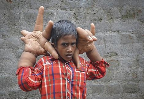 طفل هندي عمره 8 سنوات يداه أكبر من رأسه وأثقل من حجرين