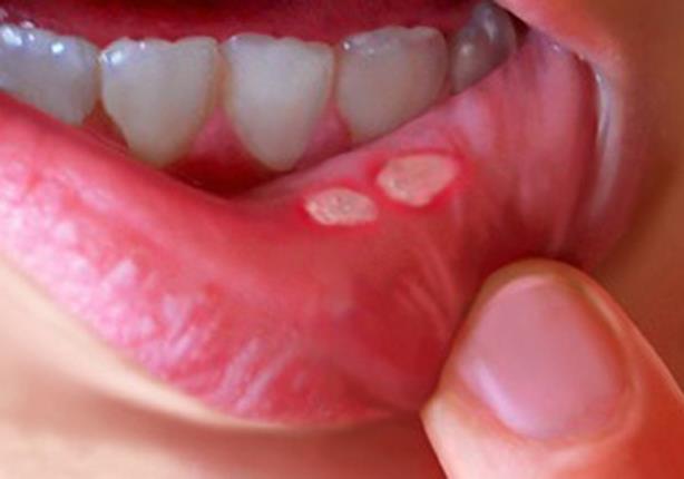علاج تقرحات الفم في المنزل | الكونسلتو