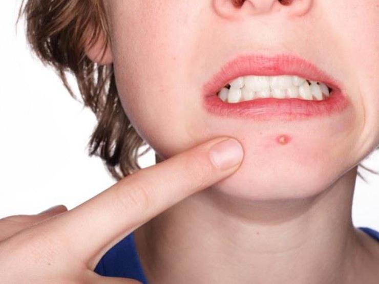 "البوس" يسبب انتشار الهربس.. وهذه طرق علاجه