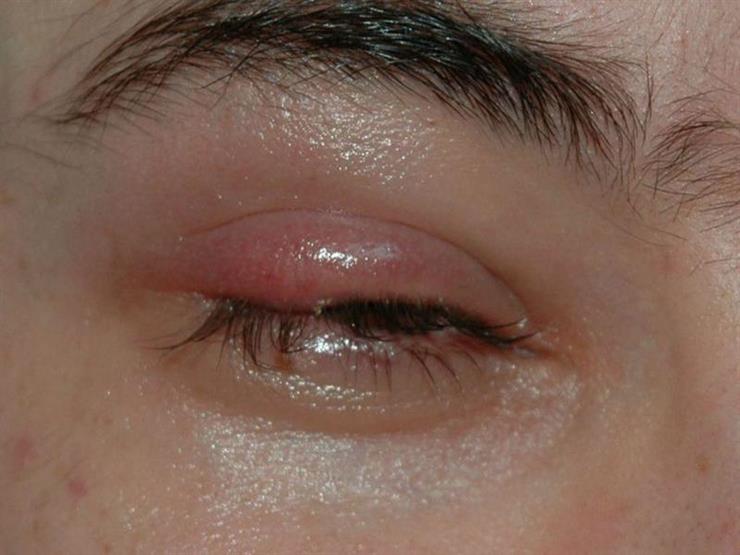 سيدة صينية تصاب بالتهاب الجفون                                                                                                                                                                          