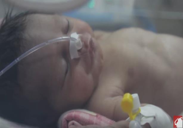 مستشفى إمبابة تشهد حالة ولادة نادرة الجنين خارج الرحم