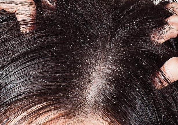 كيفية علاج قشرة الشعر 
