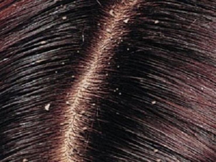 وصفة طبيعية للتخلص من قشرة الشعر 