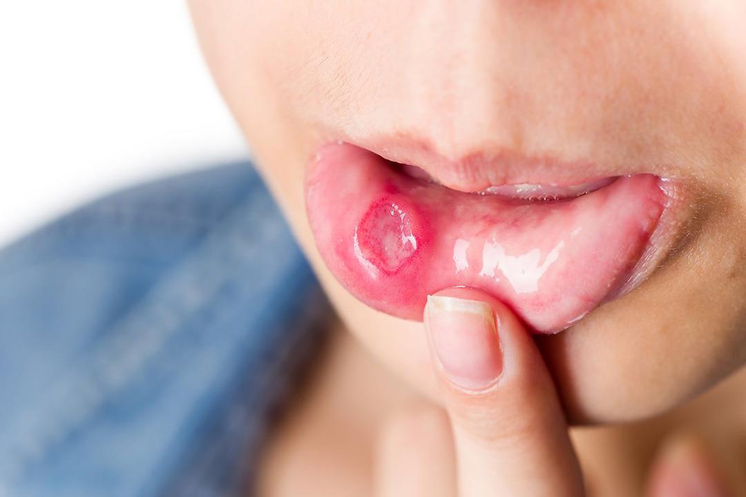 نظام غذائي لمواجهة فرط نمو فطريات الفم والأمعاء
