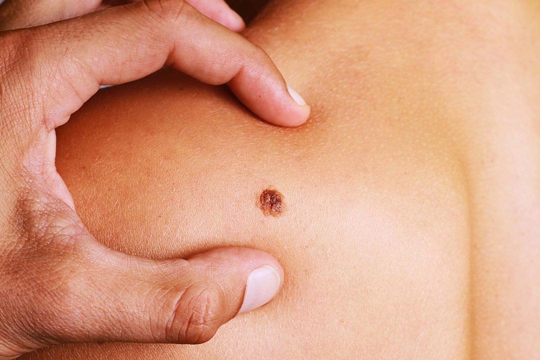 اكتشاف مضاد حيوي يعالج سرطان الجلد 