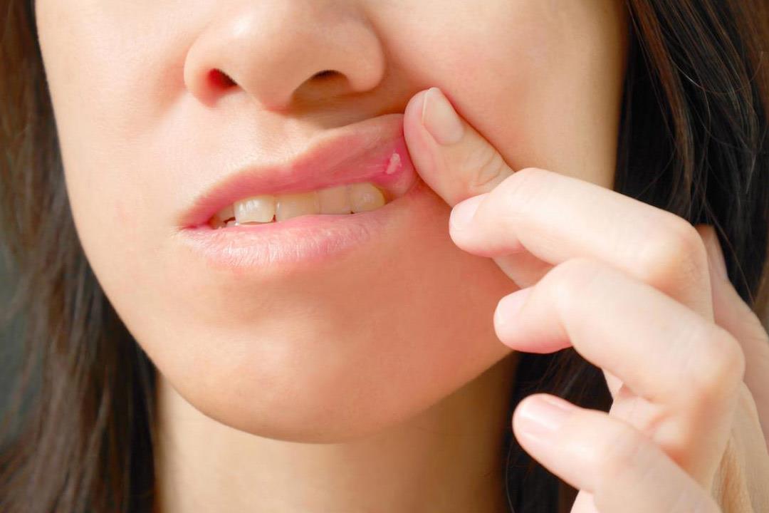 مرضى الكلى أكثر عُرضة لالتهابات أنسجة الفم.. كيف تتجنب ذلك؟