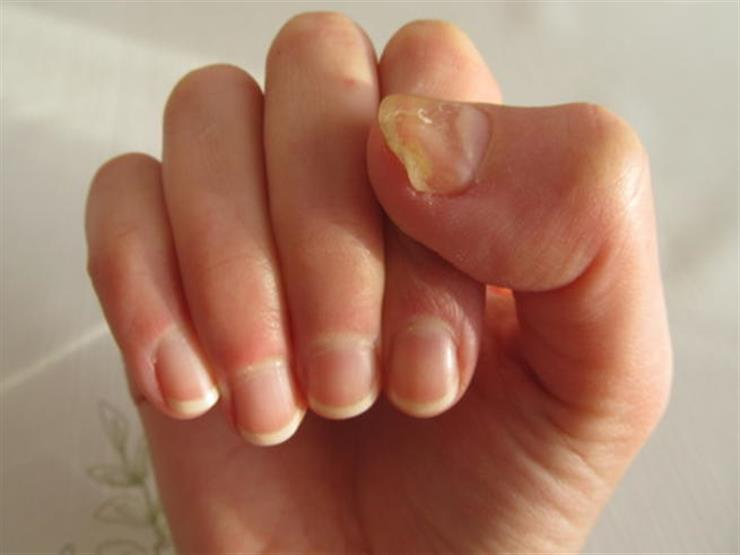 ضعف الأظافر                                                                                                                                                                                             