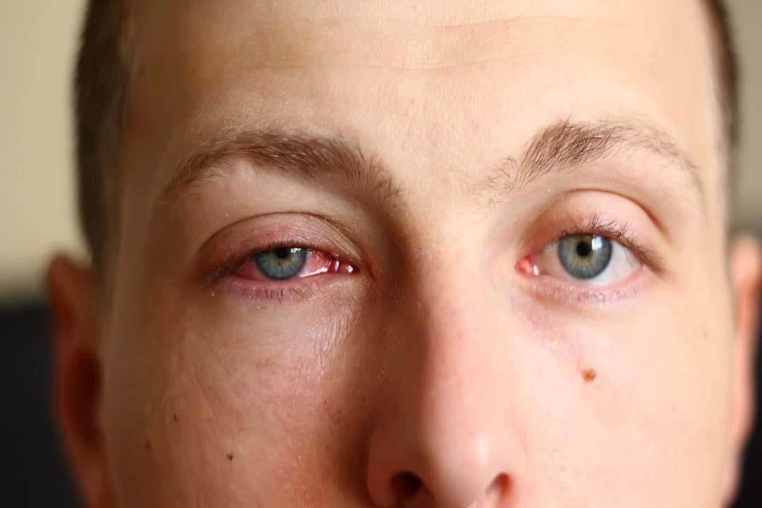 أعراض في العين تكشف إصابتك بالأمراض المنقولة جنسيًا