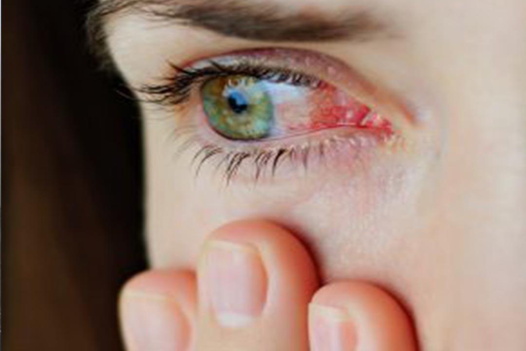فوائد الثوم لصحة العين- كيف نستخدمه؟