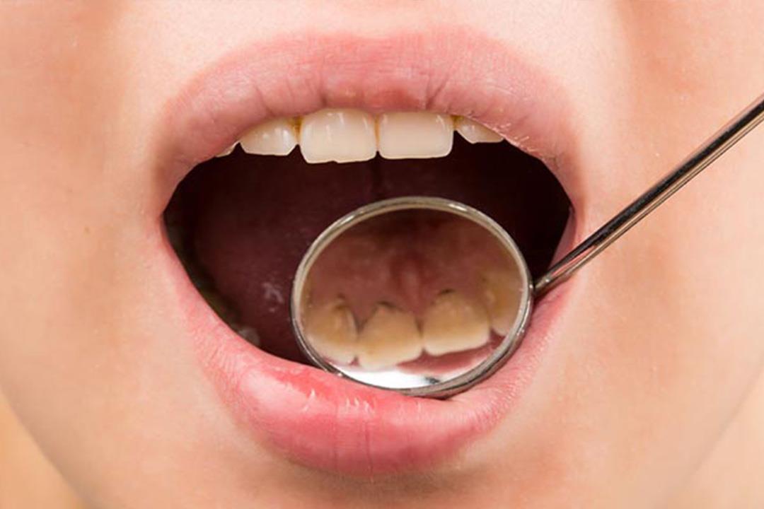 كيف نفرق بين طبقة البلاك وتسوس الأسنان وأيهما أخطر؟