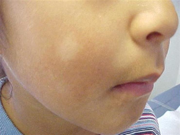 5 أسباب لظهور البقع الفاتحة على الوجه