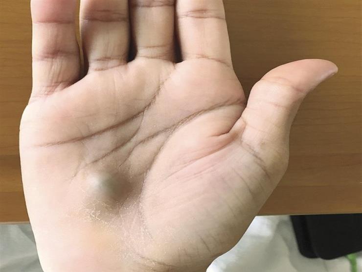 في عيادة الأسنان قد تصيبك عدوى مميتة ما أعراضها وعلاجها مصراوى