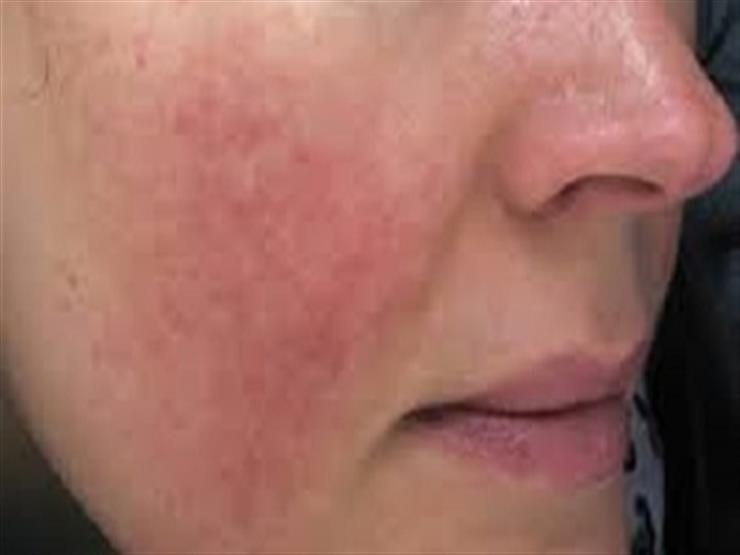 استشاري أمراض جلدية: استخدام البرفانات أثناء الشمس يسبب التهابات –فيديو