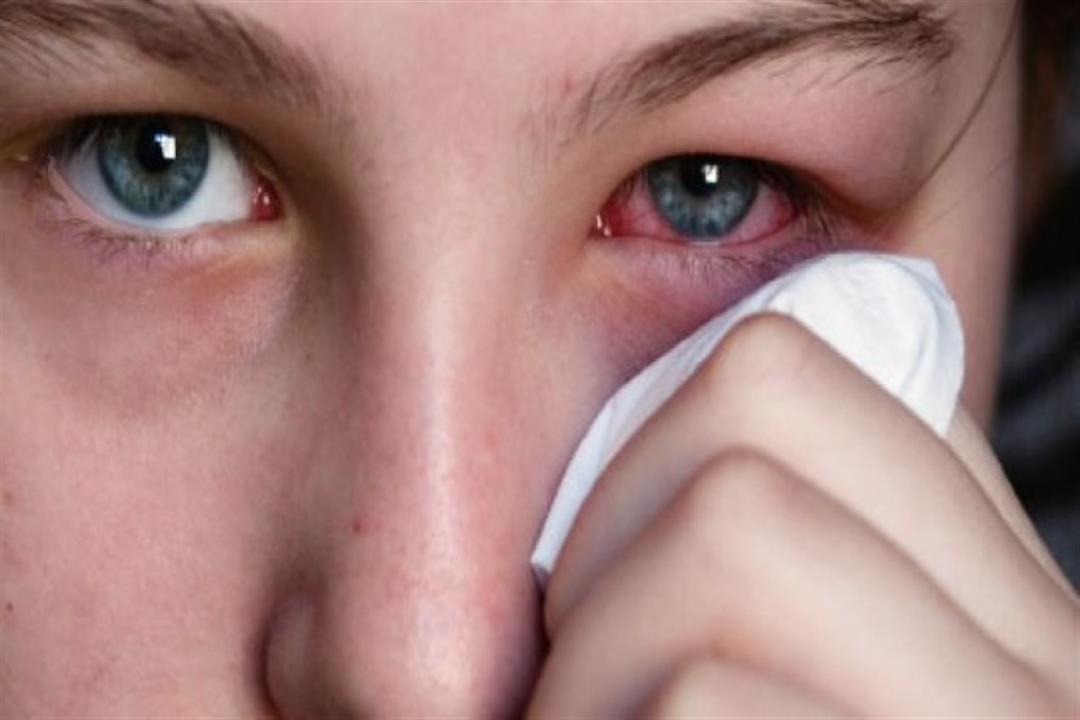 إهمال علاج الرمد الصديدي يسبب العمى.. إليك أعراضه
