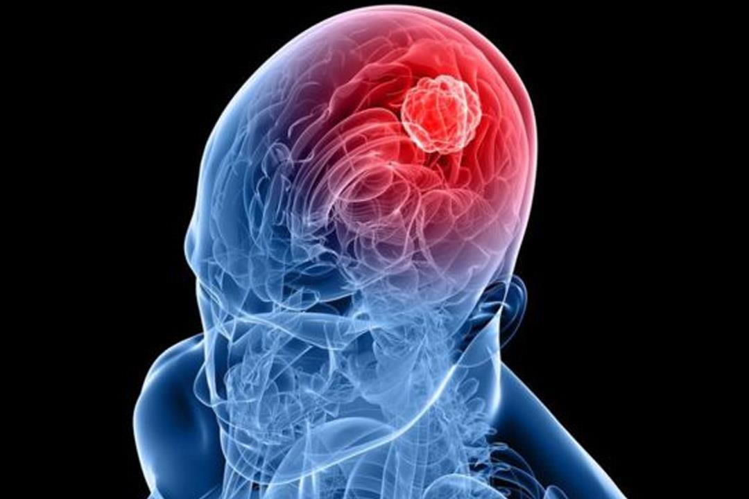 أحمد البسيوني: القسطرة التداخلية أحدث علاجات جلطات ونزيف المخ