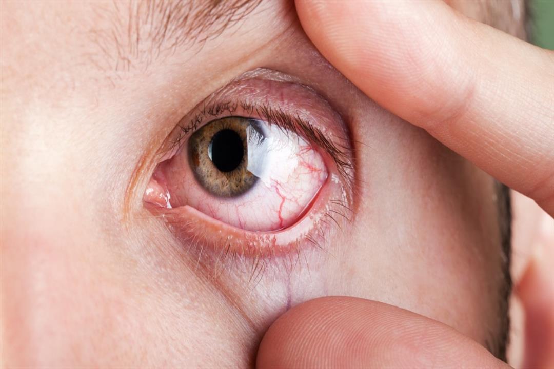 6 أعراض قد تشير للإصابة بسرطان العيون.. توجه للطبيب فورا