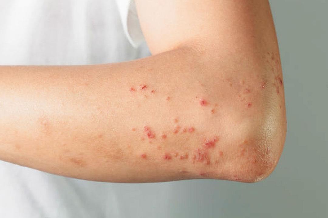 «جفاف الجلد والطفح الجلدي».. أعراض جديدة من متحور أوميكرون