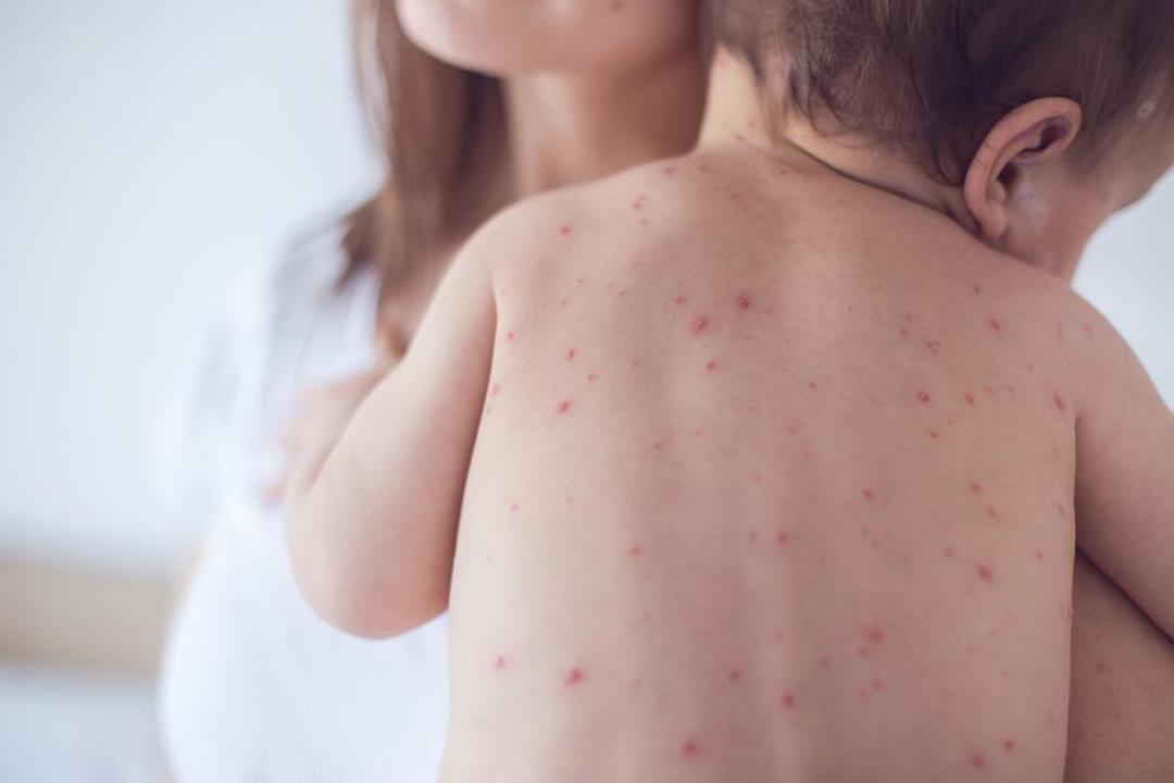 اسباب ظهور حساسية الجلد عند الاطفال البنات واحد