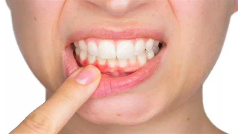 لا تتجاهل نزيف اللثة.. قد يكون مؤشر لأمراض خطيرة 
