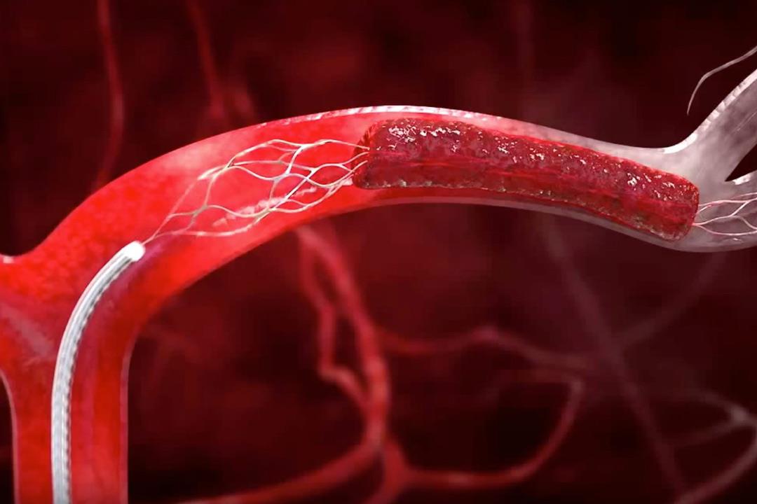 تمدد الأوعية الدموية قد يؤدي للوفاة.. تجنب عوامل الخطورة