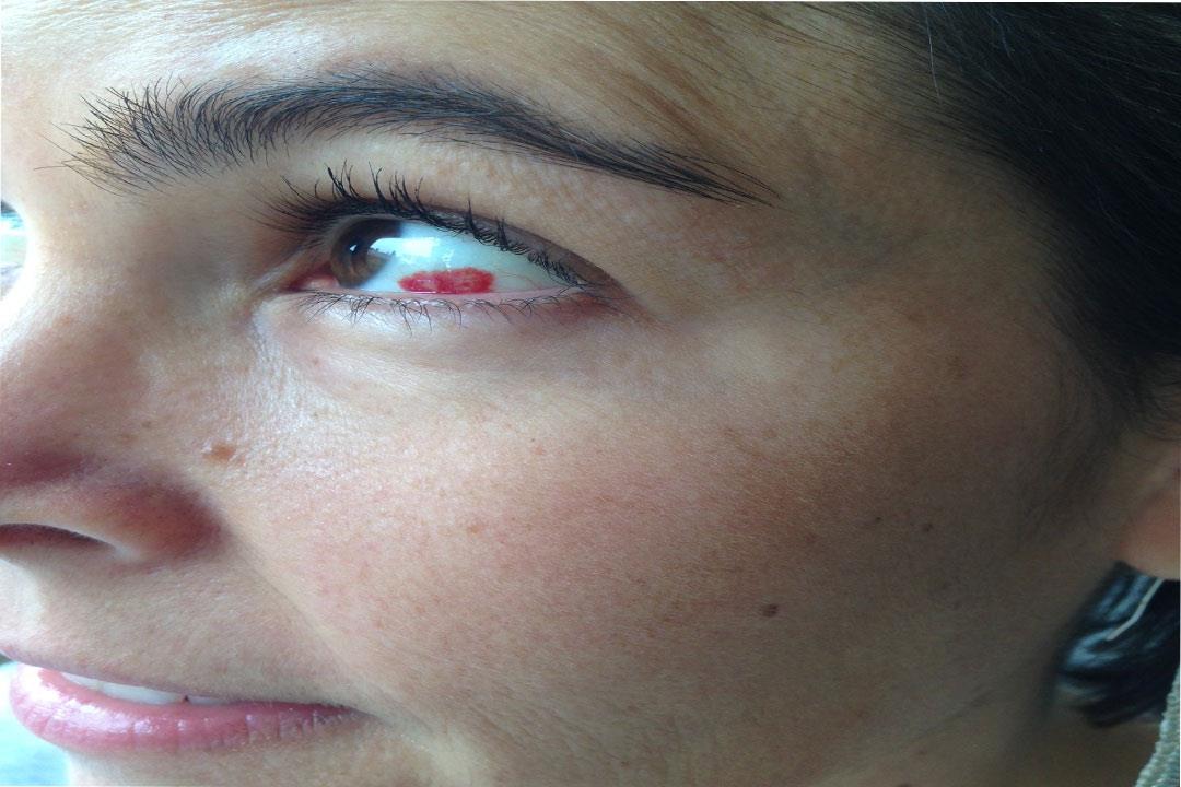 هل البقع الحمراء في بياض العين تشير لمشكلة خطيرة؟