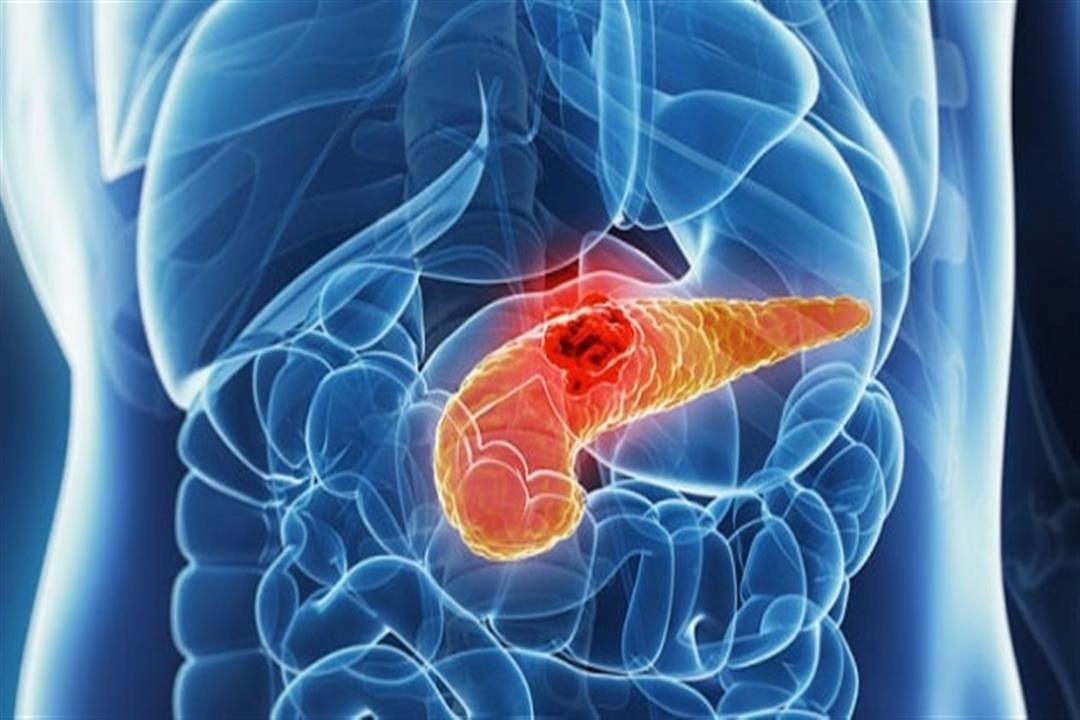 باحثون يطورون علاج قد يقضى على سرطان البنكرياس