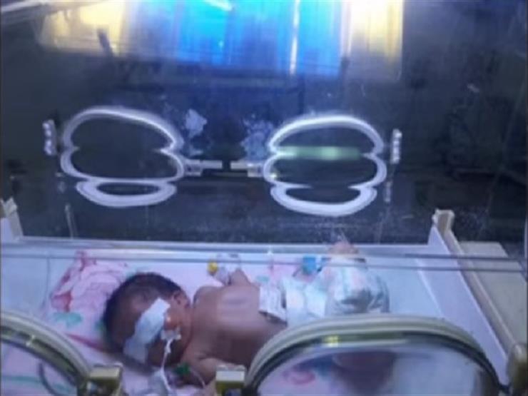 مستشفى المحلة يكشف عن تفاصيل إنقاذه رضيعة مصابة بانسداد فتحتَي الأنف