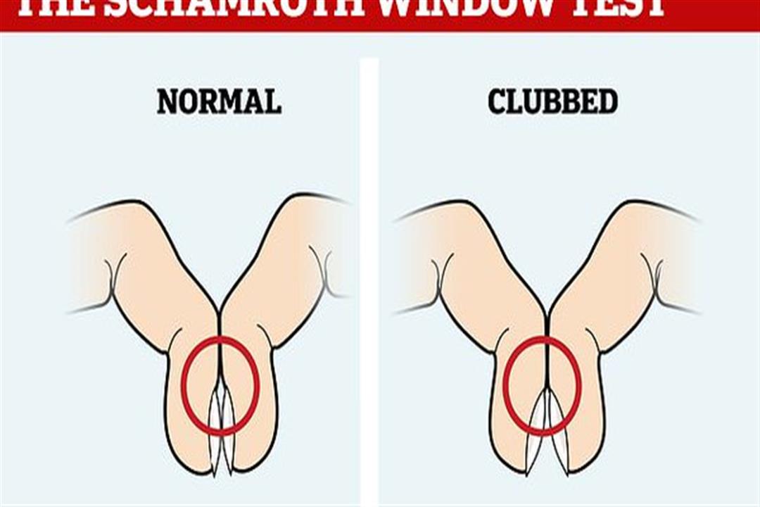 سرطان الرئة