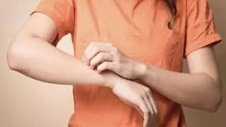 أطعمة يومية قد تخفف الصدفية.. اكتشفها الآن 