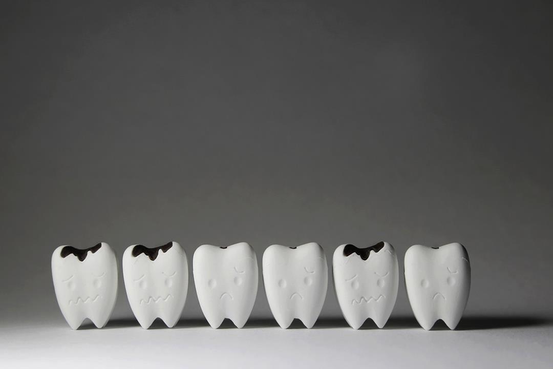 5 مضاعفات خطيرة يسببها التسوس.. منها تكسير الأسنان