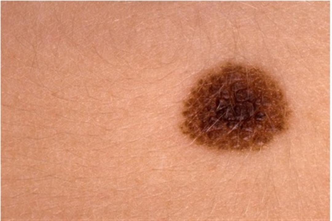 باحثون: بعض المضادات الحيوية قد تكون فعالة في علاج سرطان الجلد
