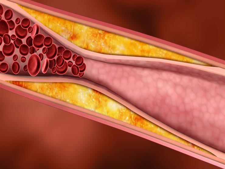 ابتكار دواء جديد يقى من الإصابة بتصلب الشرايين