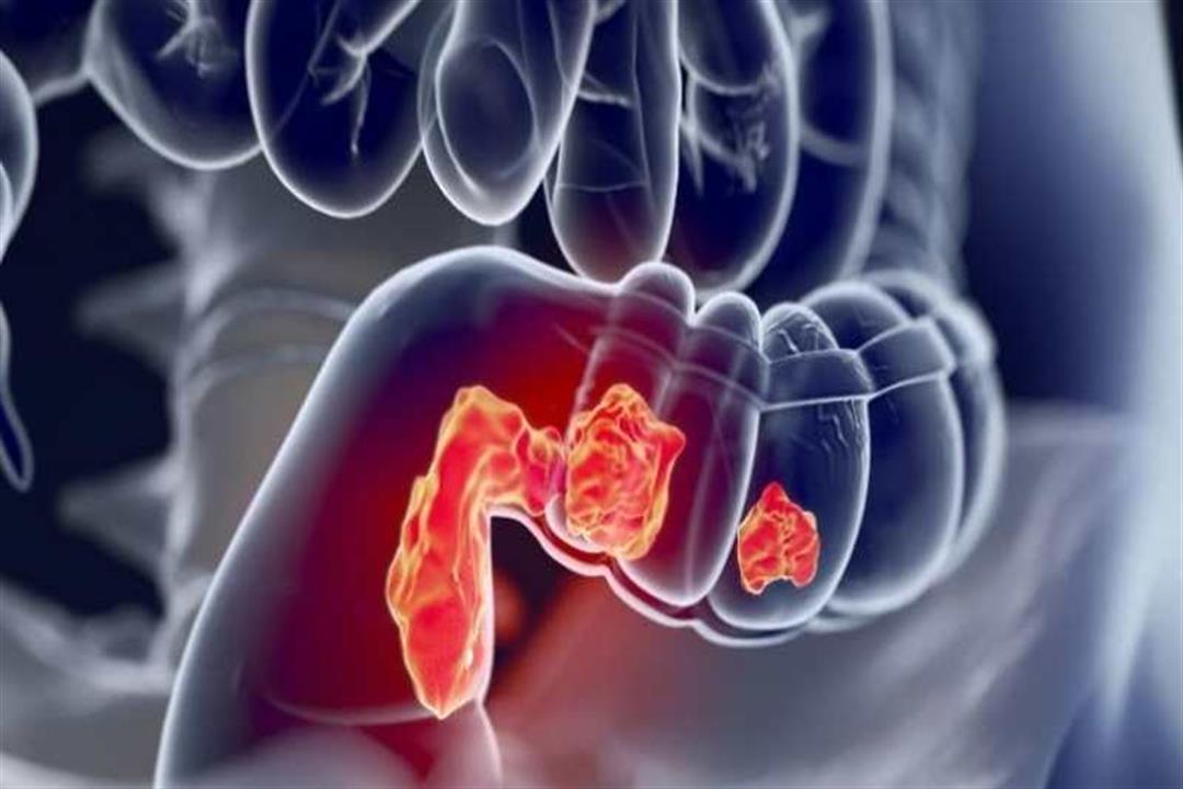 دراسة تكشف عن نظام غذائي يسبب سرطان القولون