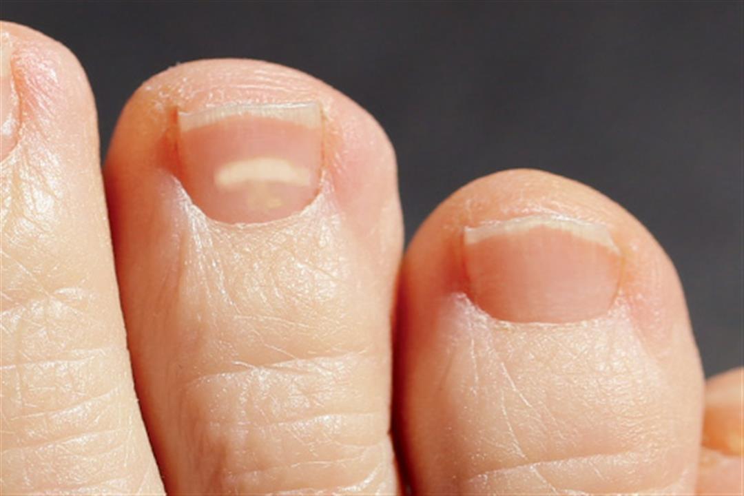 493ss_thinkstock_rf_white_spots