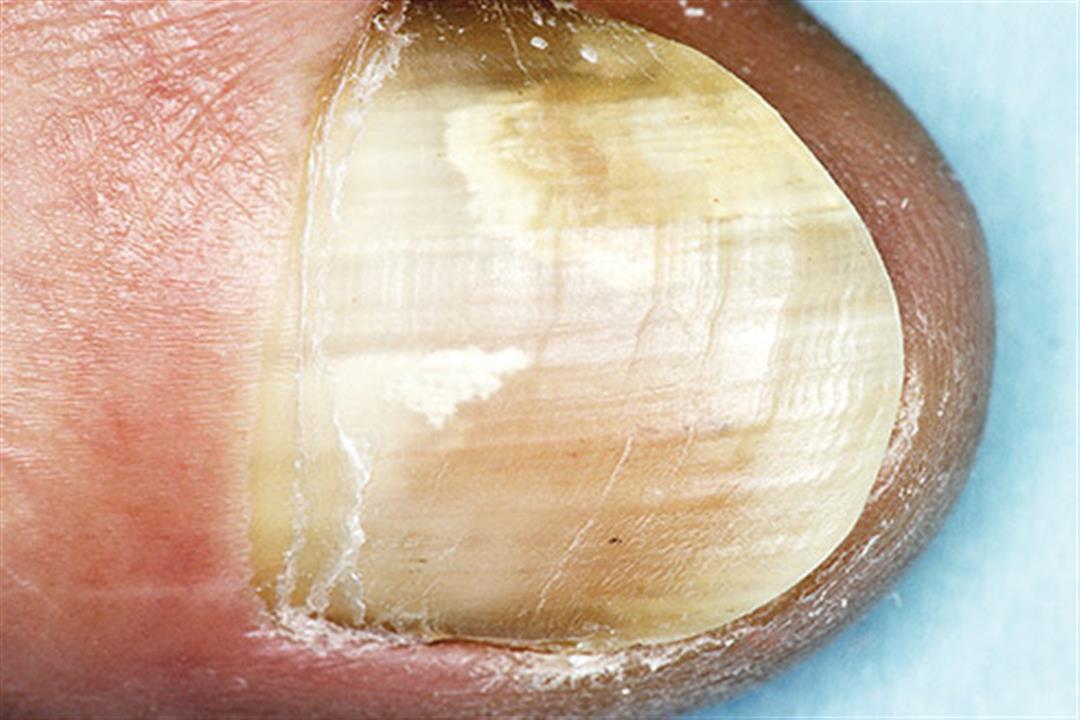 493ss_medical_images_rm_white_onychomycosis