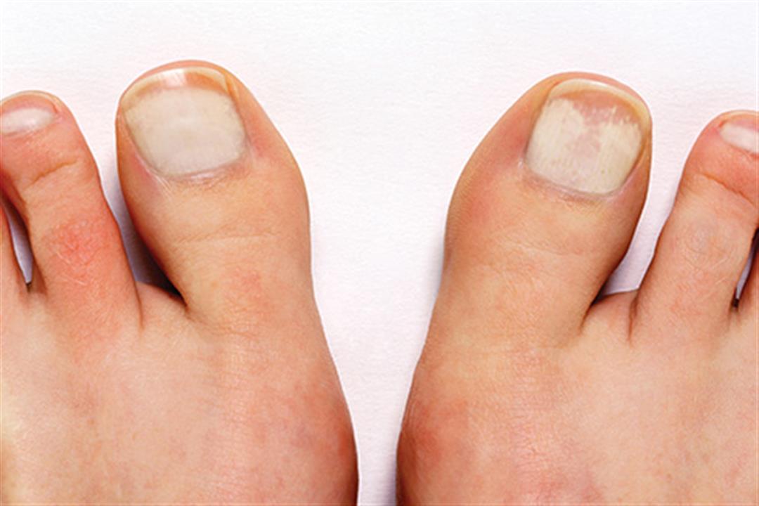 493ss_getty_rf_white_proximal_subungual_onychomycosis
