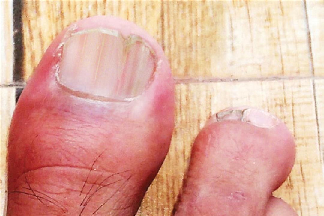 493ss_getty_rf_striped_darier_disease