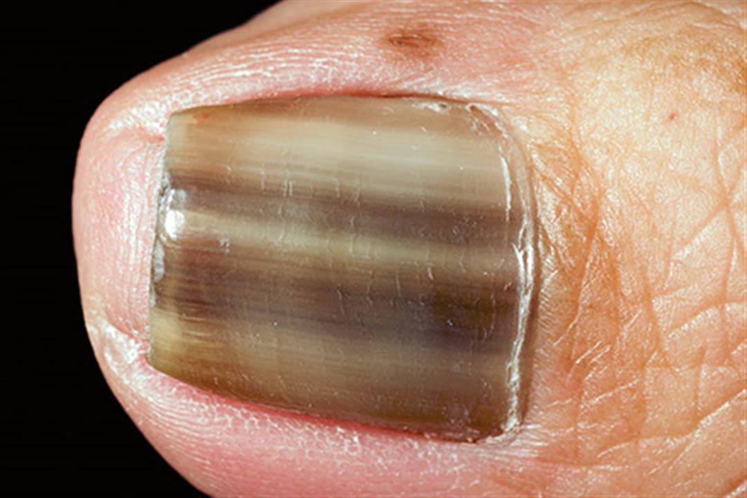 493ss_science_source_rm_brown_melanonychia