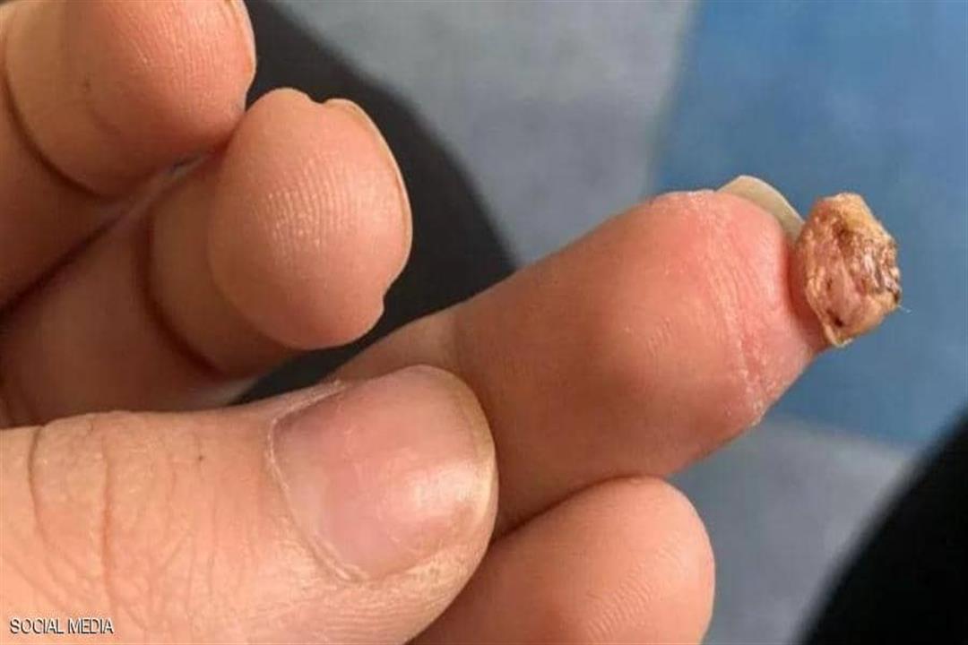 البثرة الدموية