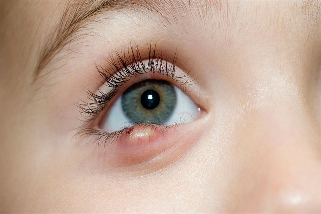 أعراض متعددة لخراج العين.. متى يحتاج للتدخل الجراحي؟