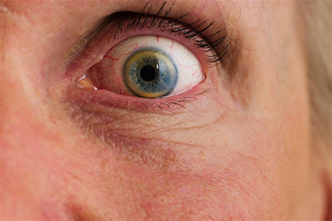 493ss_thinkstock_rf_shocked_eye